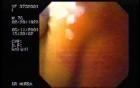 Yellowish endoscopical larynx view during ictericia