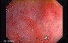 Endoscopic View Of Diverticulitis Of The Sigmoid (3 of 4)