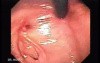 Colonic Interposition for Esophageal Substitution (9 of 11)