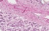 Adrenal - Atrophy
