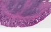 Ulcerative colitis, carcinoma, atypia - Histopathology - Colon