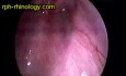 Aberrant Carotid Artery