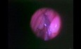 Functional Endoscopic Sinus Surgery - Anatomical Demostration - Part 2 of 5