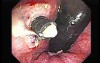 Rubber Band Ligation of Hemorrhoids (3 of 3)