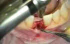 Implant Microsurgery: Implant Replaces Failing Lower Central
