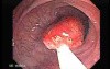 Rectal Stalked Polyp (2 of 7)