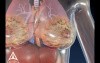 Breast cancer - 3D Medical Animation