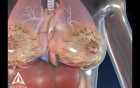 Breast cancer - 3D Medical Animation