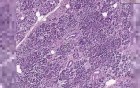 Pancreas - Adenocarcinoma