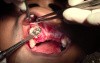 Maxillary Bone Grafting #7-8-10 Sites - Bone Grafting #7-8 Sites
