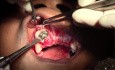 Maxillary Bone Grafting #7-8-10 Sites - Bone Grafting #7-8 Sites