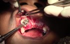 Maxillary Bone Grafting #7-8-10 Sites - Bone Grafting #7-8 Sites