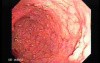 Familial Adenomatous Polyposis (20 of 36)