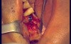 Immediate Implantation 14-18 (2/2)