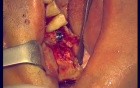 Immediate Implantation 14-18 (2/2)