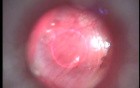 Myringotomy - Laser Method