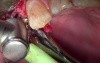 Implant Uncovery #5