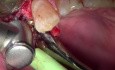 Implant Uncovery #5