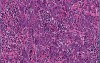 Neoplasia - MSP - 7b