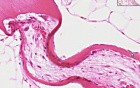 Hyperparathyroidism - Histopathology - Bone