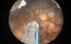 Greenlight HPS - Prostate After Brachytherapy