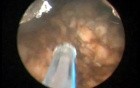Greenlight HPS - Prostate After Brachytherapy