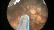 Greenlight HPS - Prostate After Brachytherapy