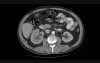 Bladder Cancer T4 - CT scan