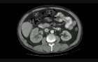 Bladder Cancer T4 - CT scan