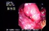 Rectum Adenocarcinoma - Retroflexed Image