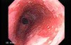 Barrett's Esophagus of long segment (4 of 24)