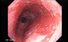 Barrett's Esophagus of long segment (4 of 24)