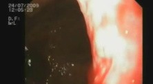 Achalasia