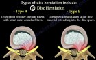 Disc herniation of the lumbo sacral spine