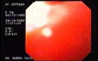 Endoscopic laryngeal view by patient with icterica