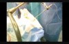 Endoscopy And Biopsy Of Brain With Neuropanacea
