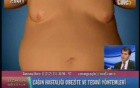 Obesity Treatment