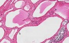 Lymphangioma (cystic hygroma) - Histopathology of neck