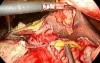 Laparoscopic omental patch repair PPU
