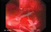 Severe Bleeding of the Upper Digestive System After Two Days of Band Ligation - Extensive Bleeding