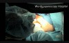 TEM - Transanal Endoscopic Microsurgery