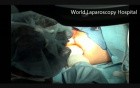 TEM - Transanal Endoscopic Microsurgery