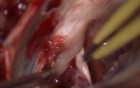 Hemifacial Spasm - Left Retrosigmoid Approach