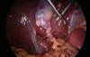 Laparoscopic suturing and knotting