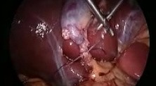 Laparoscopic suturing and knotting