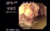 Colon Adenocarcinoma - 67 Year - Old Woman