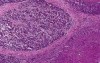 Hepatocellular carcinoma in cirrhosis - Histopathology - Liver