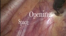 Endoscopic thoracic sympathectomy video
