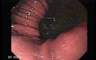 Hiatus Hernia (1 of 3)