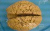Cerebrum- Autopsy View